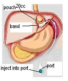 Laparoscopic adjustable gastric band (LAGB)